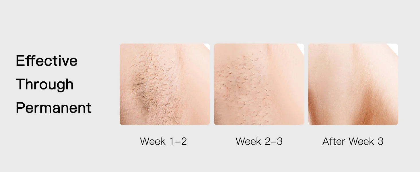 Hair Reduction in 3 Weeks
